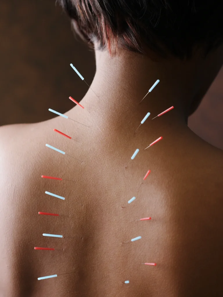 Acupuncture