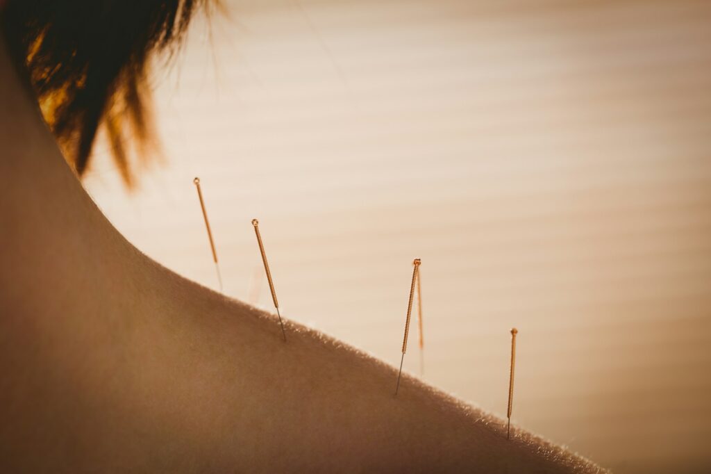 Client Receiving Acupuncture In Shoulders